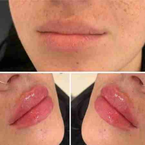 Lip filler