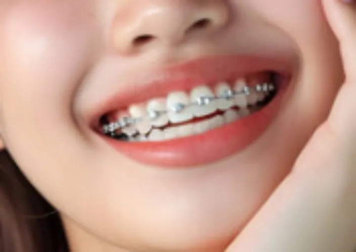 help me to get braces 