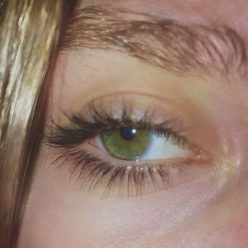 Laser Eye Surgery