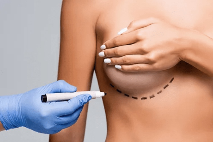 Breast Surgery