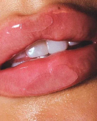 lip filler 