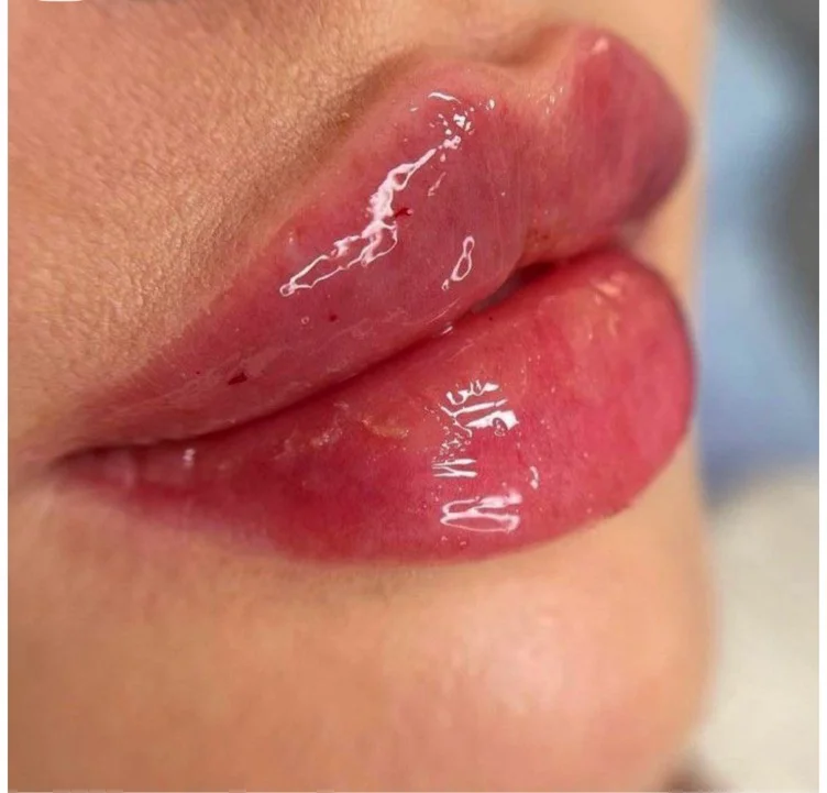 Lip filler 💋