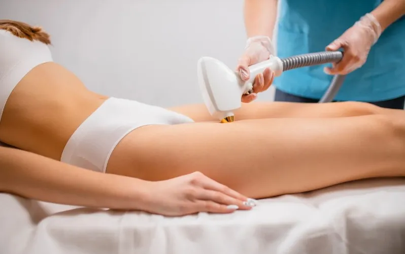 laser hair removal treatment