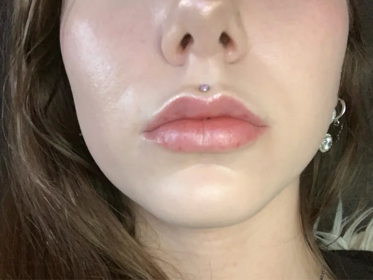Lip Filler 