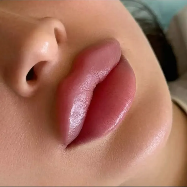 Bimbo 1ml lip fillers