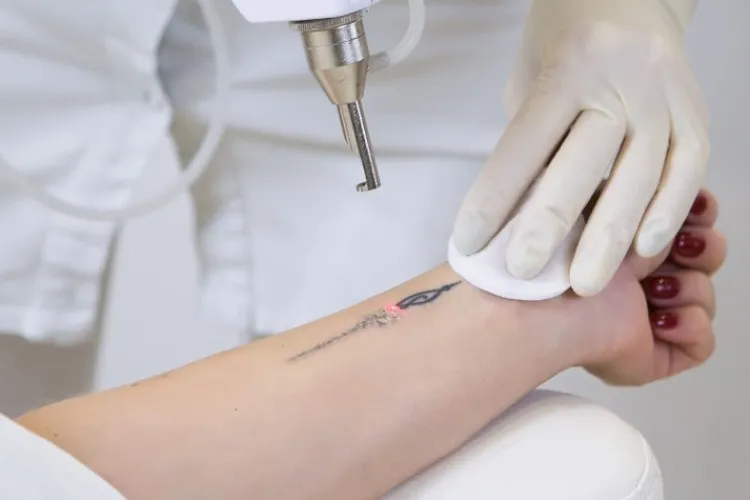 Remove Tattoo (Laser)