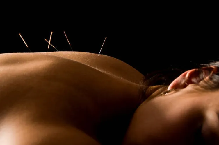 acupuncture  