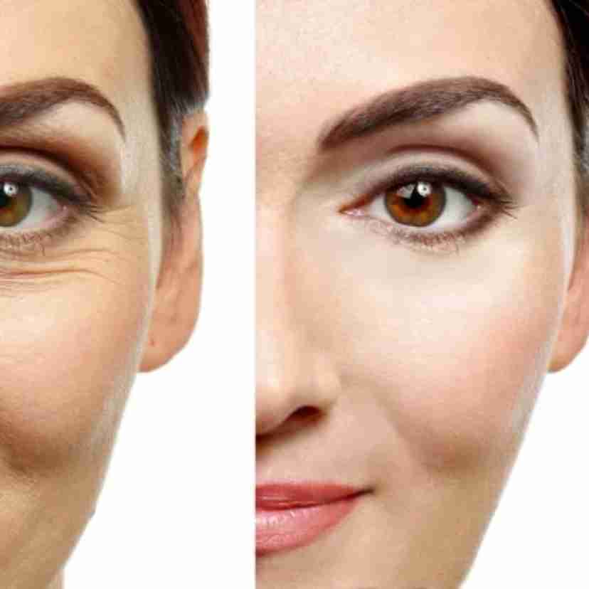 1 botox treatment 