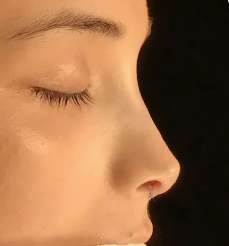 rhinoplasty 👃🏻