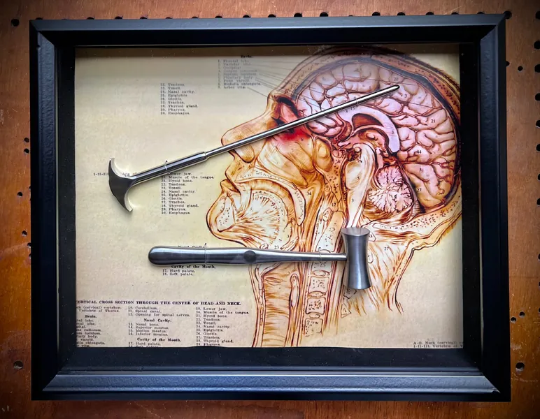 BESTSELLER! Lobotomy Shadowbox Display Large