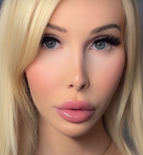 Lip filler💋
