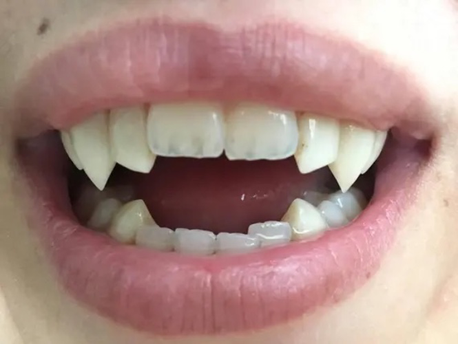 Permanent Vampire Fangs Fund